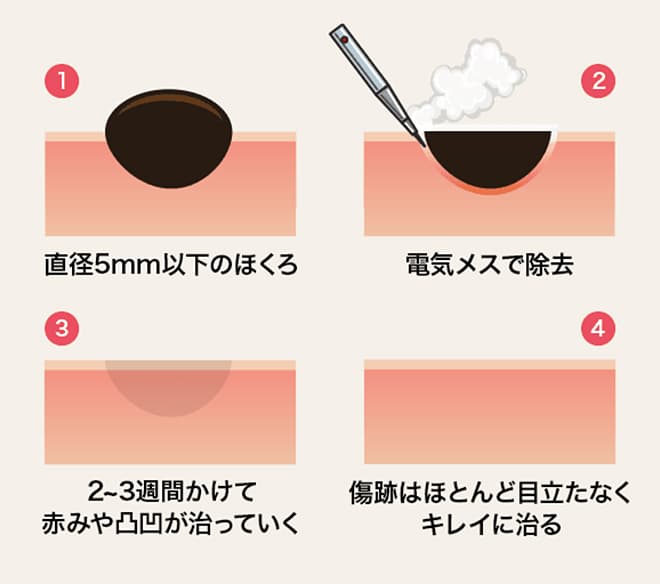 ①直径5mm以下のほくろ ②電気メスで除去 ③2～3週間かけて赤みや凸凹が治っていく ④傷跡はほとんど目立たなくキレイに治る