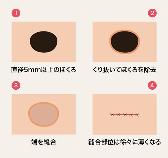 ①直径5mm以下のほくろ ②くり抜いてほくろを除去 ③端を縫合 ④縫合部位は徐々に薄くなる