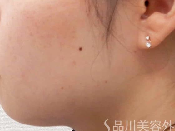 一般的なほくろ（母斑細胞性）のイメージ