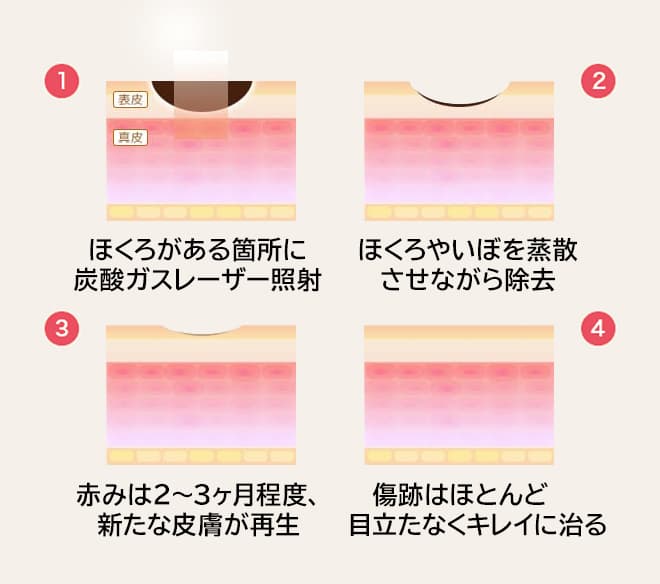 ①ほくろがある箇所に炭酸ガスレーザー照射 ②ほくろやいぼを蒸散させながら除去 ③赤みは2～3ヶ月程度、新たな皮膚が再生 ④傷跡はほとんど目立たなくキレイに治る