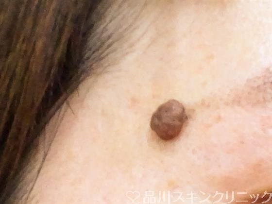 イボのイメージ