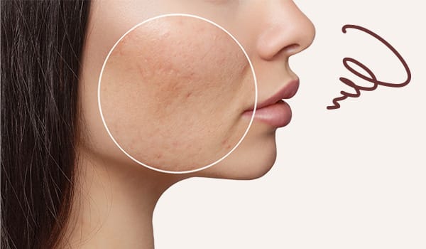 セルフケアが難しいクレーターのニキビ跡が気になる？【画像】