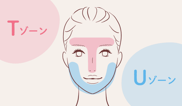 クレーターのニキビ跡ができやすい箇所【画像】