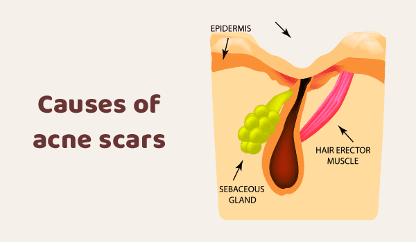 クレーターのニキビ跡ができる原因【画像】