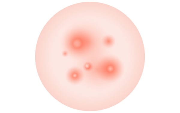 赤いニキビ【画像】