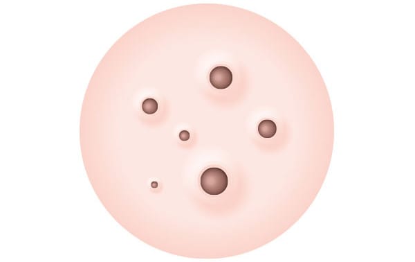 黒いニキビ【画像】