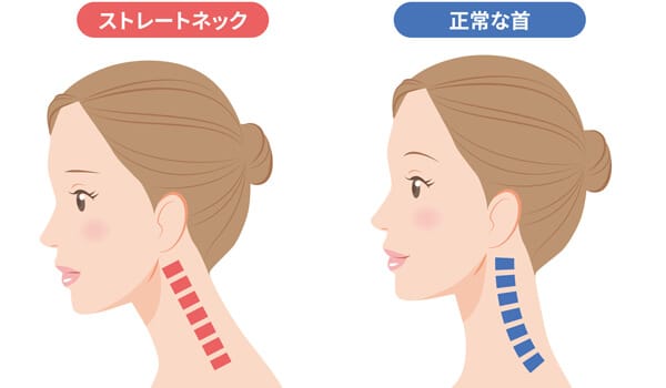 スマホ首になっている【画像】