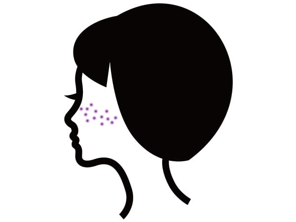 後天性真皮メラノサイトーシス【画像】