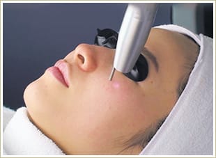 レーザートーニング【画像】