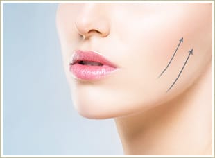 美肌糸リフト【画像】