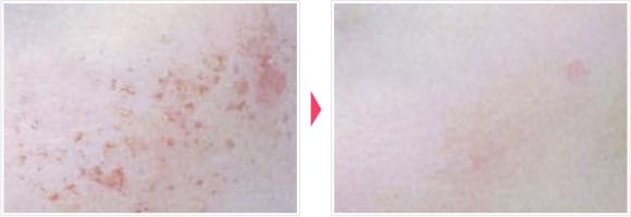 フォトシルクプラス 症例写真 Before After【画像】