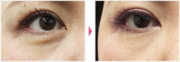 美肌注射 症例写真 Before After【画像】