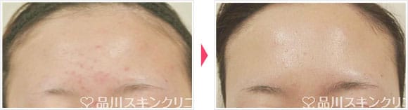 パール美肌 症例写真 Before After【画像】