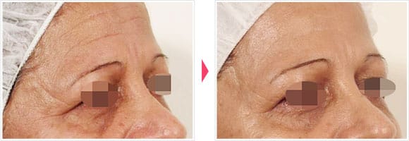 オキシジェネオ（Oxy Geneo） 症例写真 Before After【画像】