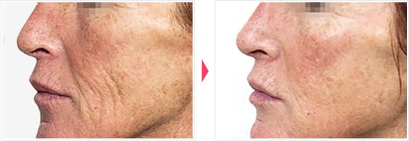 コラーゲンピール 症例写真 Before After【画像】