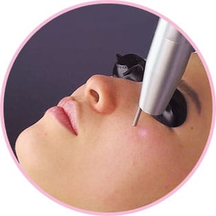 レーザートーニング【画像】