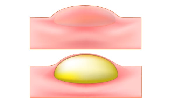 赤ニキビ・黄ニキビ【画像】