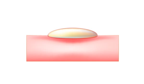 白ニキビ【画像】