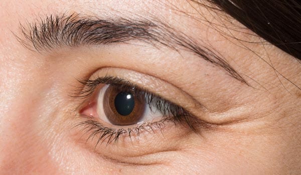 目元のエイジングケアの悩み【画像】