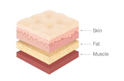 脂肪の除去【画像】
