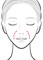 ヒアルロン酸でほうれい線を目立たなく【画像】