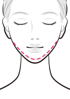 1日脂肪取り®顔痩せ注射でアゴのラインを整える【画像】