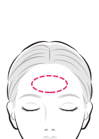 ヒアルロン酸によりおでこに丸みを出す額注入【画像】