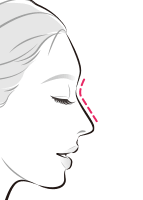 ヒアルロン酸により鼻筋を高く【画像】