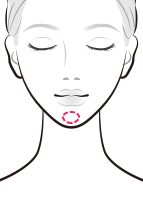 ヒアルロン酸による注入でシャープなアゴを【画像】