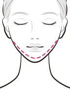 1日脂肪取り®顔痩せ注射でムダな脂肪を取り除く【画像】