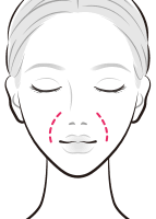 ヒアルロン酸でほうれい線を目立たなく【画像】