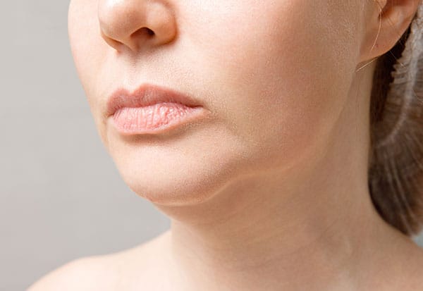 フェイスラインのたるみとは【画像】