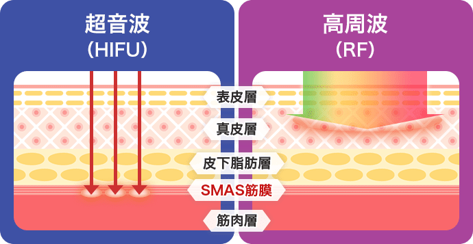 超音波と高周波の違い【画像】