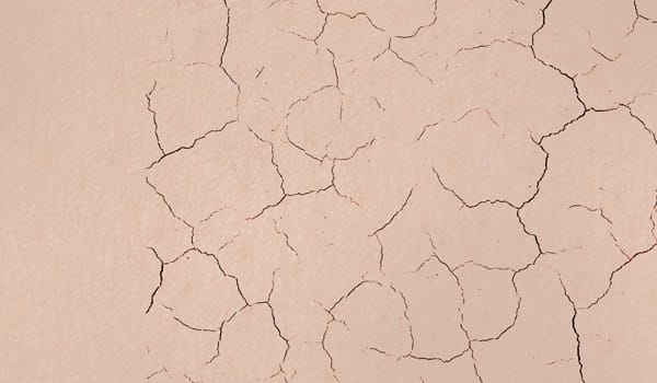 術後は肌が乾燥しやすくなる【画像】