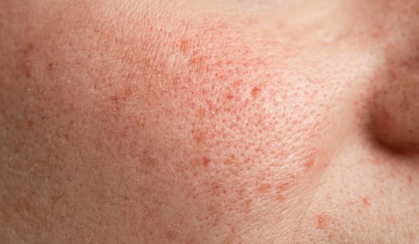 毛穴の開き【画像】