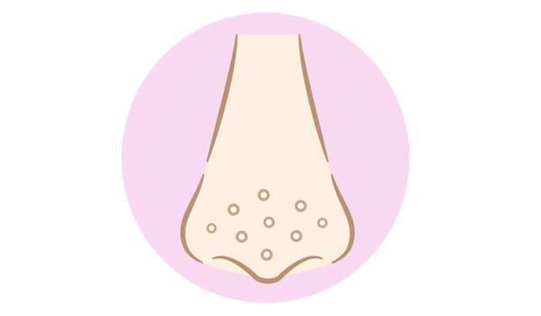 毛穴の開きや産毛がいちご鼻に見える場合も！【画像】