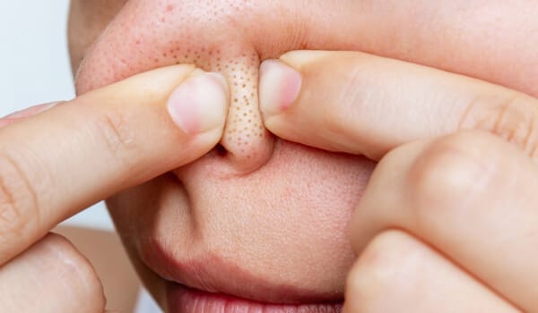 指で角栓を押し出してしまうこと【画像】