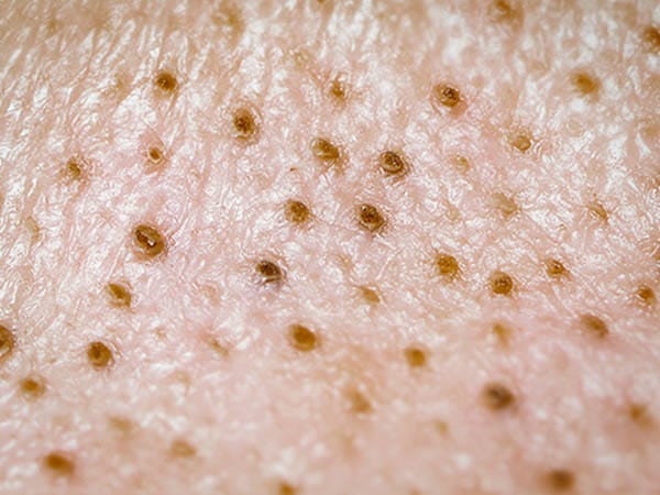 角栓とは【画像】