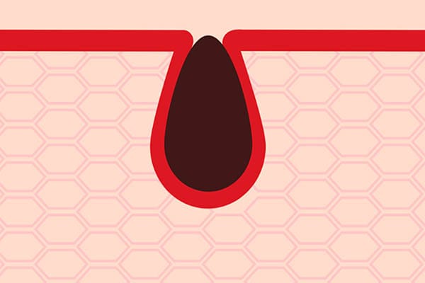 毛穴の汚れ【画像】