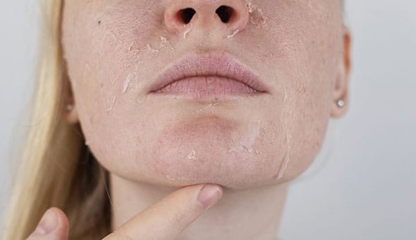 レーザー治療後の経過について【画像】