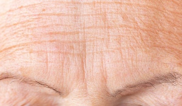 おでこの「細かいシワ」におすすめの改善対策【画像】