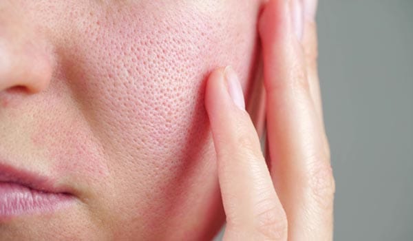 毛穴の開き（開き毛穴）とは？【画像】