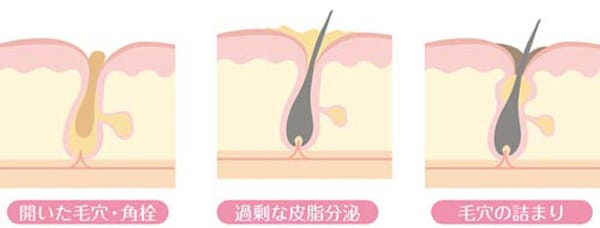 毛穴の開き（開き毛穴）の原因【画像】