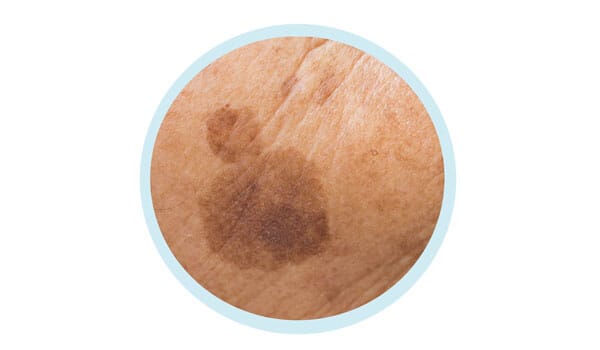 老人性色素斑【画像】