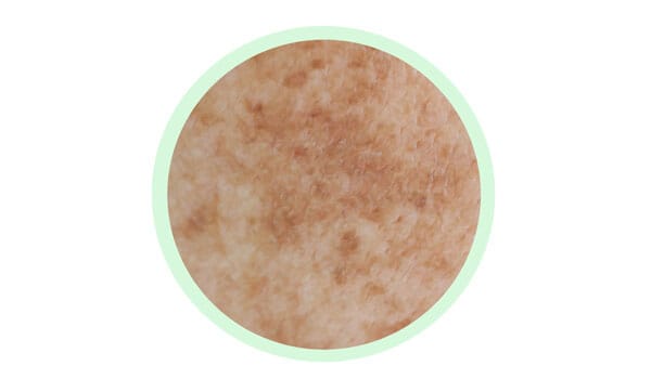 炎症性色素沈着【画像】