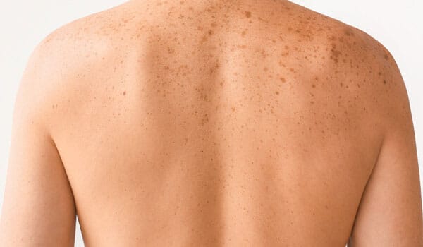 花弁状色素斑【画像】