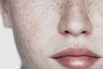 年々濃く広がっていくシミ【画像】