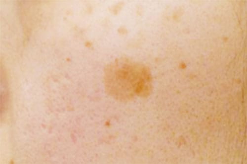 老人性色素斑（日光黒子）【画像】