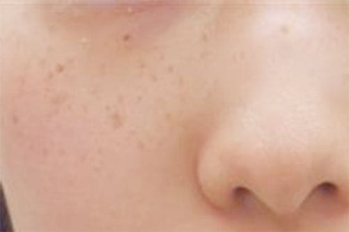 雀卵斑（そばかす）【画像】