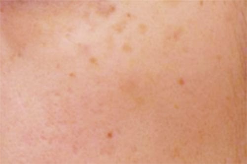 ADM 後天性真皮メラノサイトーシス【画像】